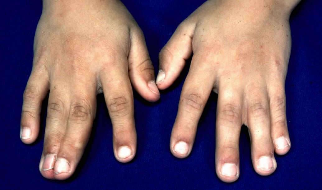 Syndactyly, An Overview